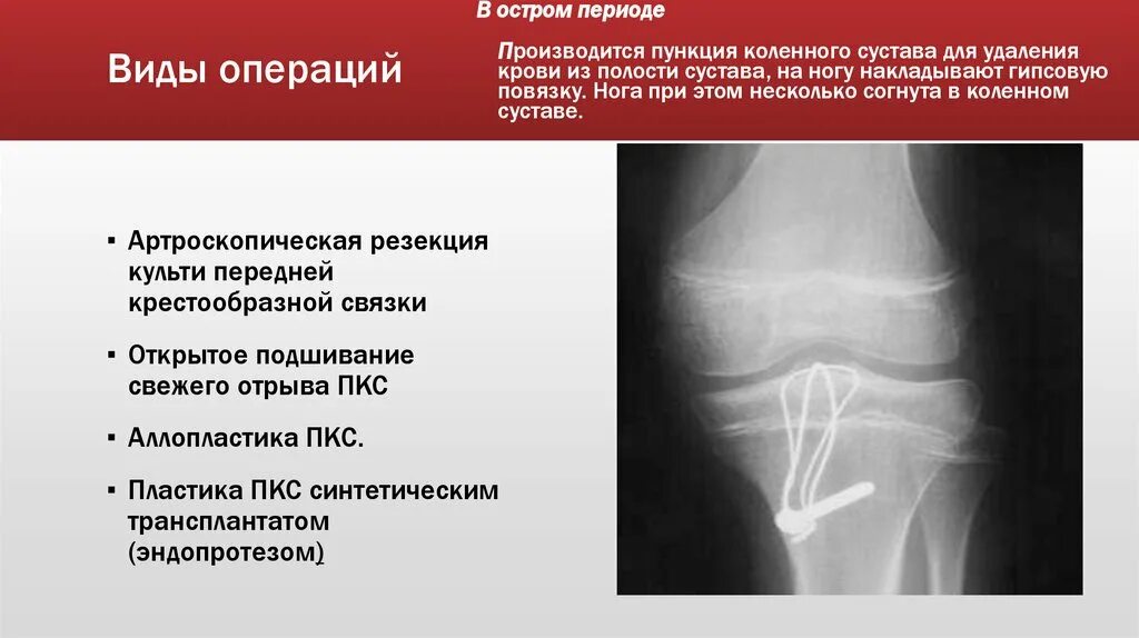 Капсульно-связочный аппарат коленного сустава. Повреждения связочного аппарата презентация. Разрыв капсульно связочного аппарата колена. Растяжение капсульно-связочного аппарата коленного сустава.