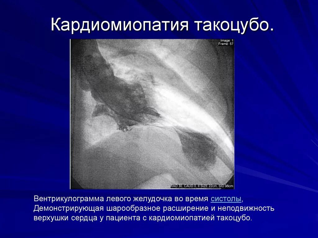 Синдром разбитого сердца симптомы. Экг при кардиомиопатии такоцубо. такоцубо синдром экг признаки. синдром такоцубо эхокг.