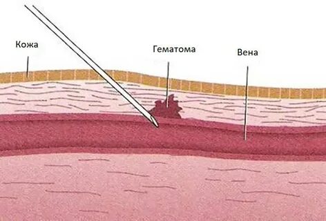Гематома при внутривенной инъекции