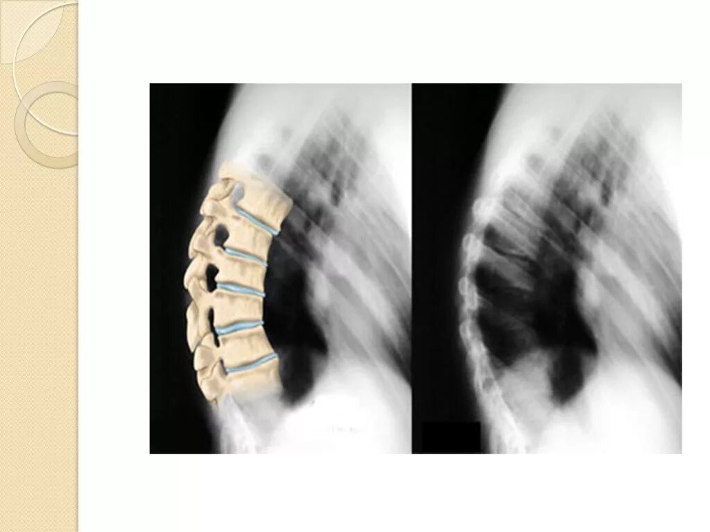 Искривление позвоночника болезнь Шейермана МАУ. - Гиперкифоз (болезнь Шейермана-МАУ). Болезнь Шейермана МАУ рентген. Шермана МАУ позвоночника.
