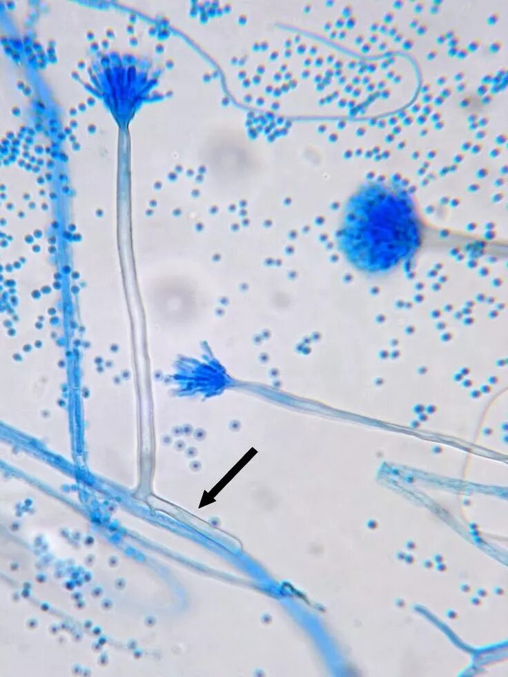 Лептотрикс лечение. Aspergillus Ferrus. Aspergillus Niger нативный препарат. Микроскопия аспергилл.