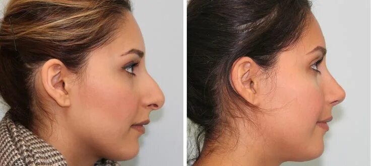 Here Is The Solution For Your Perfect Nose