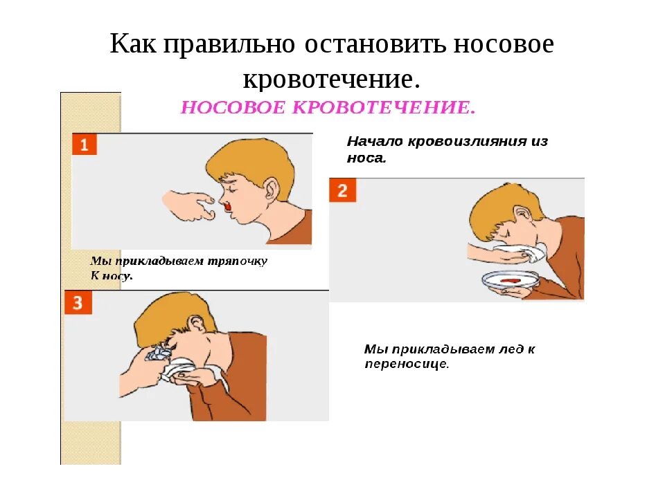 Ребенок 7 лет идет кровь из носа. Остановка носового кровотечения. Как Остановить носовое кровотечение. Какостанововить носовое кровотечение. Носовое кровотечение оказание первой помощи.