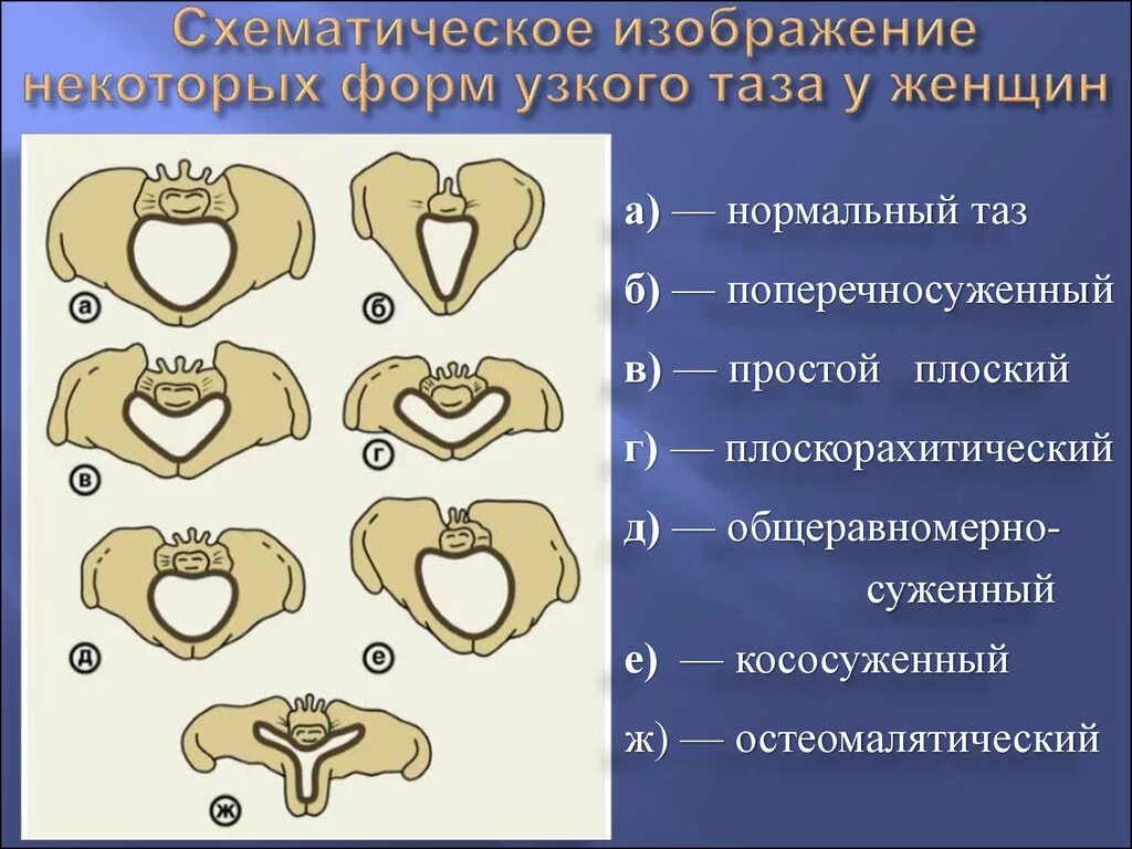 Кесарево узкий таз. Формы узкого таза в акушерстве. Классификация Малиновского узкий таз. Анатомически узкий таз классификация. Формы сужения таза Акушерство.