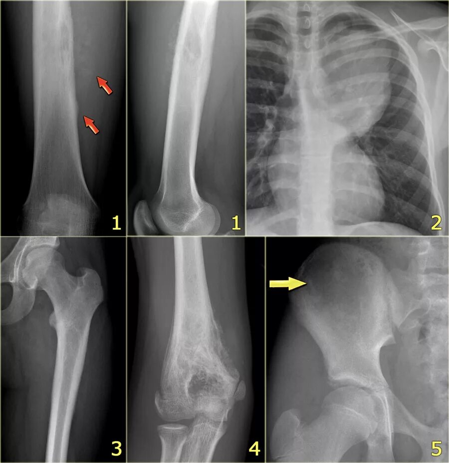 Чем отличается саркома. Опухоль Юинга у детей рентген. Саркома кости на рентгенограмме.