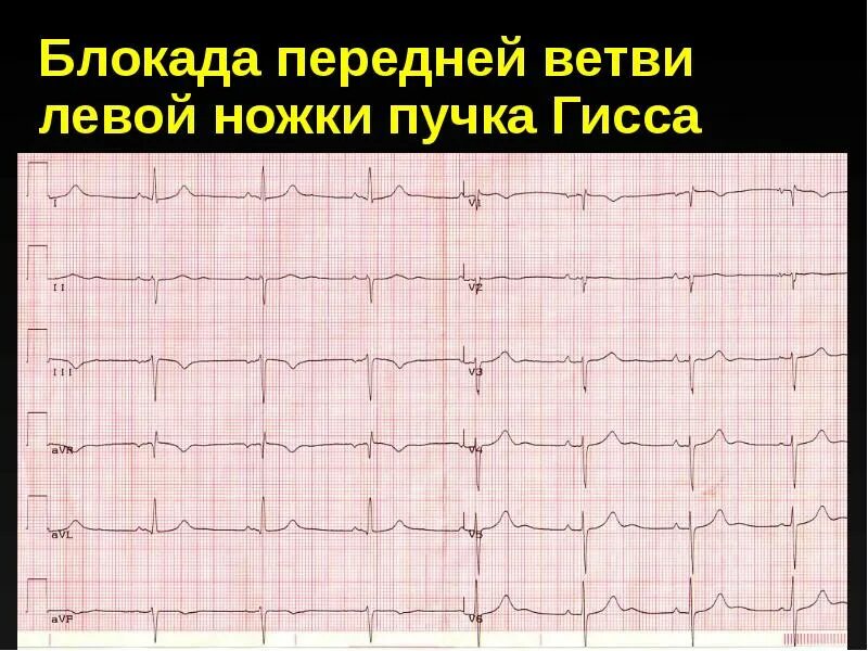 Блокада левой задней ножки. Блокада передней ветви левой ножки пучка Гиса на ЭКГ. Блокада задней ветви левой ножки пучка Гиса на ЭКГ. Блокада передней ножки левой на ЭКГ. Блокада левой ветви левой ножки пучка Гиса.