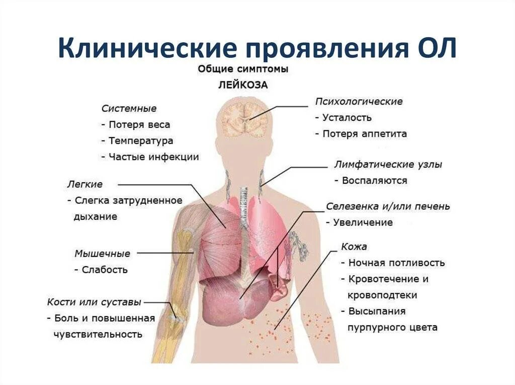 Острый миелобластный лейкоз признаки. Острый лейкоз клиническая картина. Острые миелоидные лейкозы проявления. Острый миелобластный лейкоз пациент. Лейкоз характеризуется