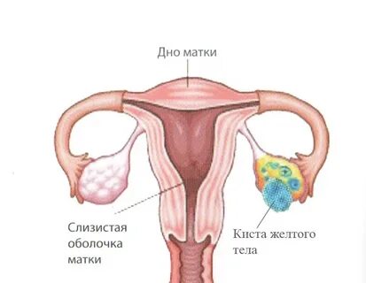 Код мкб киста правого яичника