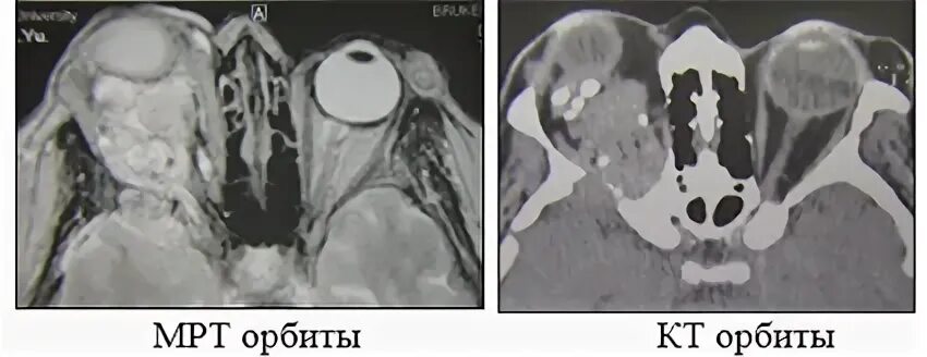 Рабдомиосаркома орбиты. Экзофтальм на кт. Кт орбит экзофтальм. Опухоли орбиты