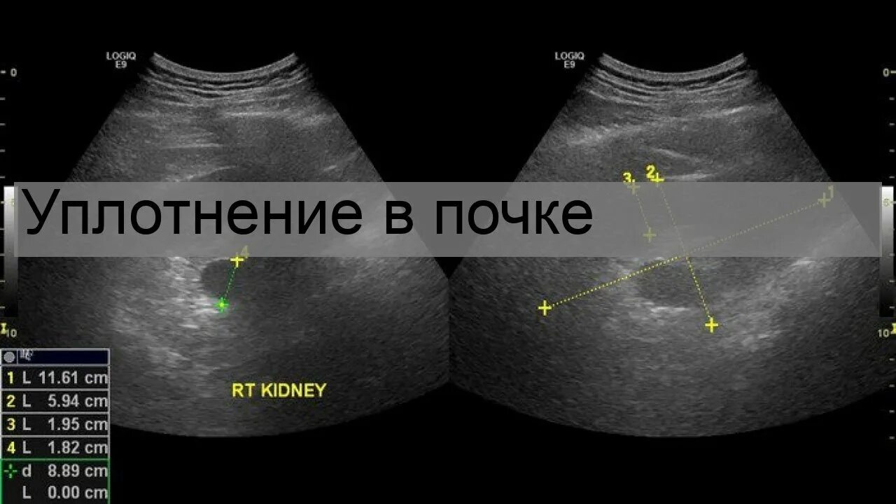 Изменение синусов обеих почек. Утолщение ЧЛС почек на УЗИ. Уплотнение ЧЛС на УЗИ. Уплотнение чашечек почек на УЗИ. Измерение почечной лоханки на УЗИ.