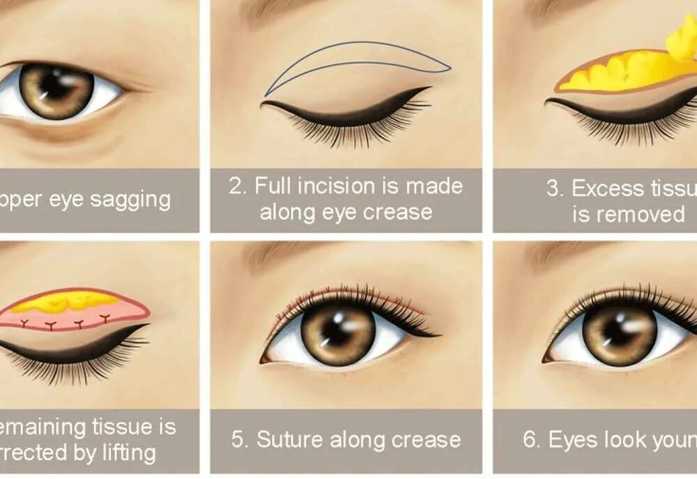 Макияж лисий взгляд. Моделирование формы глаза. Блефаропластика с кантопексией что это. Макияж с эффектом лисьих глаз. Лисий разрез.