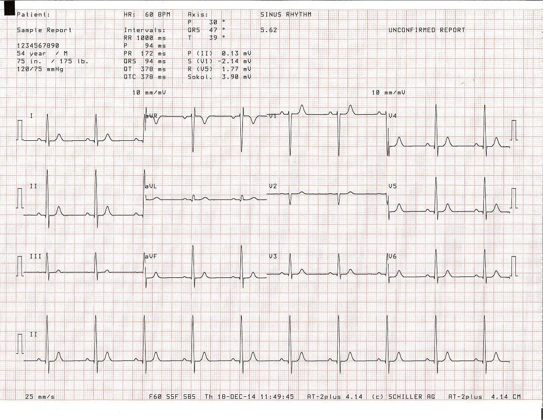 Экг программа. Тип коннектора на экг шиллер. ecg report example. ekg this is. ekg tushuncha.