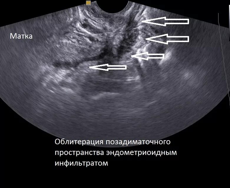 Узи признаки эндометриоза матки. Ретроцервикальный эндометриоз на УЗИ. Эндометриоз тела матки на УЗИ. УЗИ признаки ретроцервикального эндометриоза. Внутренний эндометриоз тела матки УЗИ.