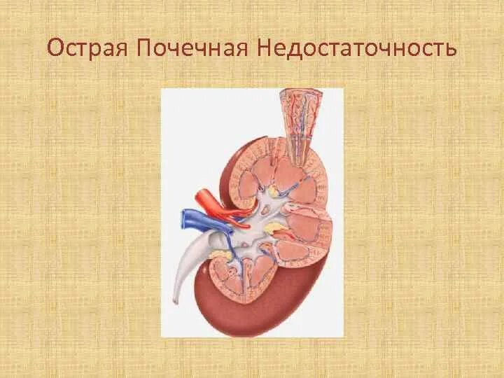 Остро печеная недостаточность. Острая почечная недостаточность. Острая почечная недостатьс. Опн хпн