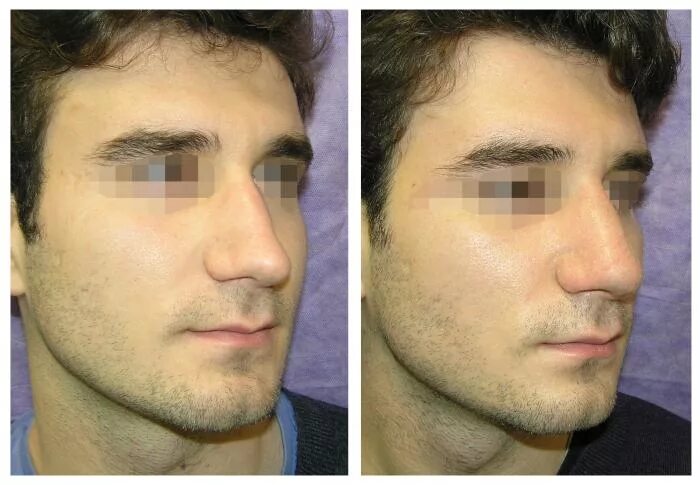 Ринопластика кончика носа мужская. Бабич после операции на нос