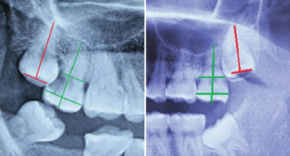 Удаленные зубы мудрости. Кривой зуб мудрости рентген. Непрорезавшийся зуб мудрости. Болит семерка