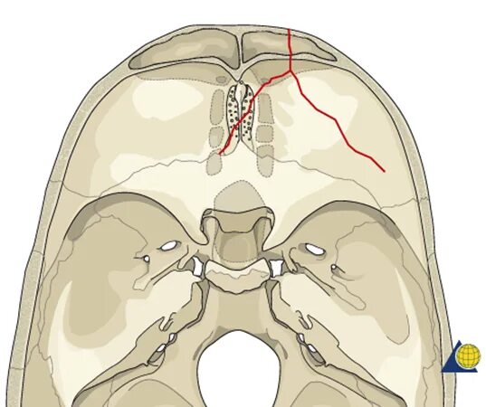 Для перелома основания черепа характерно. Перелом свода основания черепа. Перелом костей передней черепной ямки. Перелом передней черепной ямки рентген. Перелом кости основания черепа.
