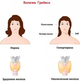 Как узнать симптомы щитовидки у женщин