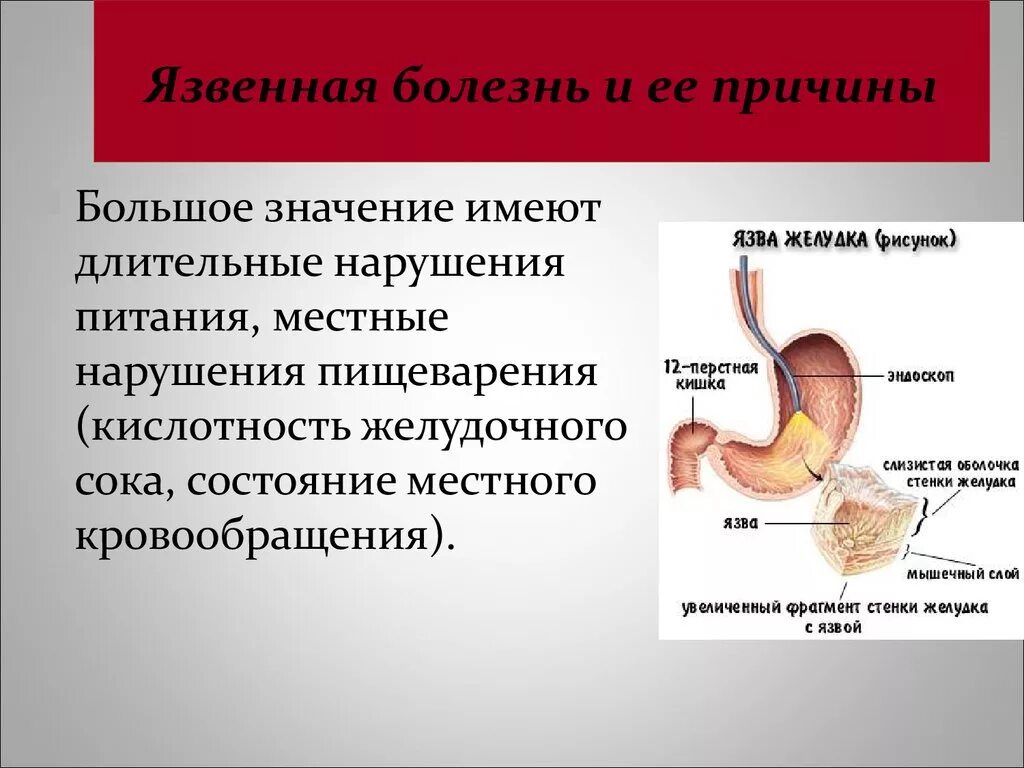 Лечение язвы желудка и 12 перстной кишки. Язвенная болезнь болезнь желудка и 12 перстной кишки. Заболевания желудка и 12 перстной кишки. Язва желудка и 12 перстной кишки. Причины заболевания язвенная болезнь желудка 12-перстной кишки.