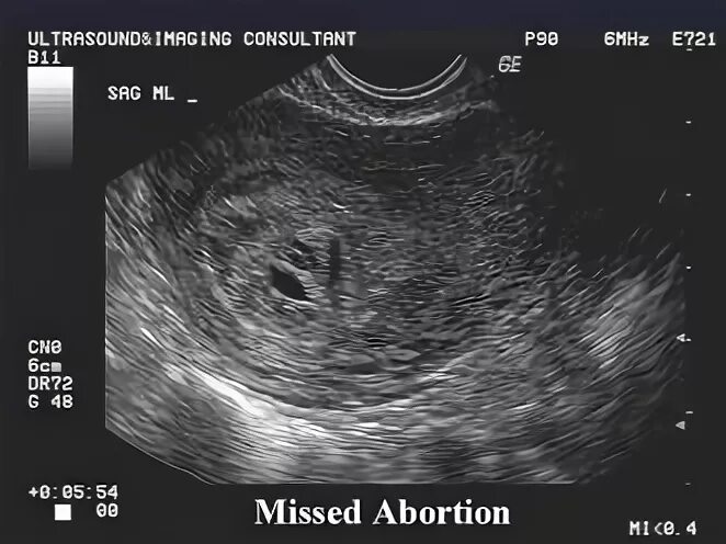 6 недель учиться. 6 Недель беременности аборт. Аборт на 17 неделе беременности. Хирургический аборт на 11 неделе. Замершая беременность фото.