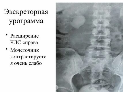 Расширенная члс