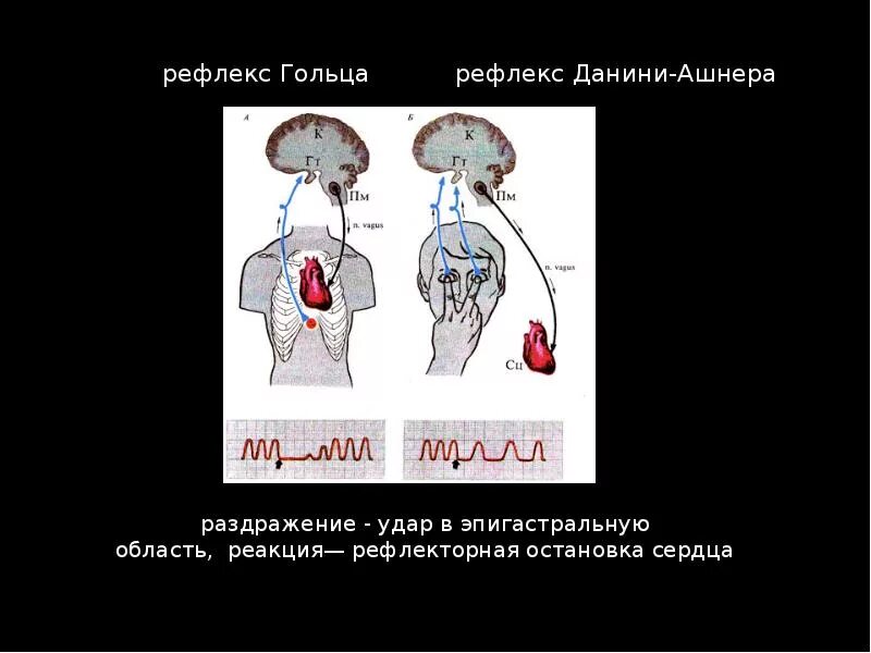 Рефлекс Данини Ашнера. Рефлекторный путь рефлекса Данини-Ашнера. Рефлекс Данини Ашнера физиология. Схема рефлекса Даньини-Ашнера.