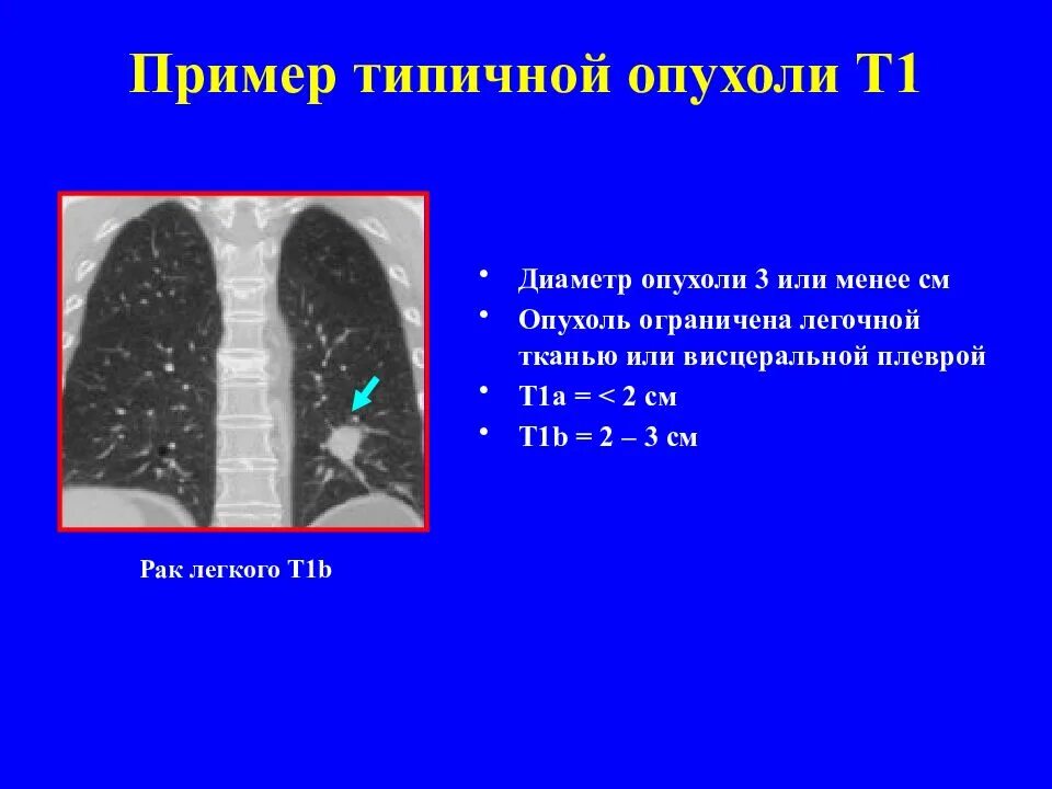 Стадии рака бронха. Опухоли легких классификация. Злокачественные опухоли легких классификация. Опухоль правого легкого.