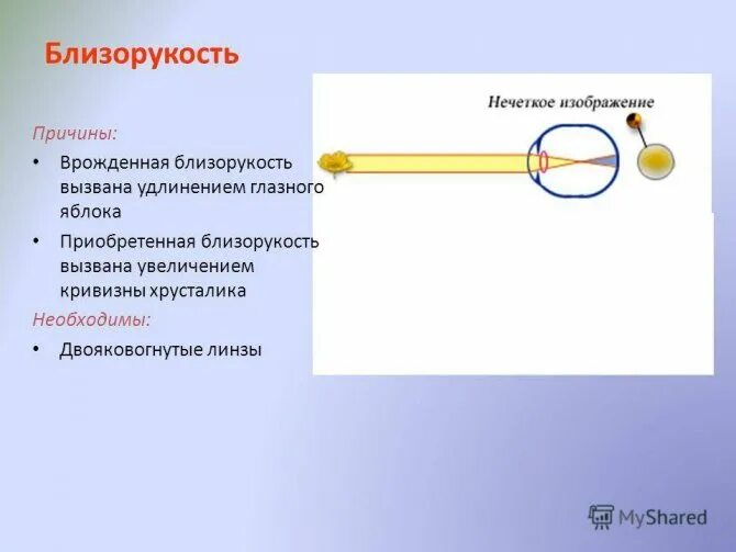 Причины возникновения миопии. Причины близорукости. Причины развития миопии. Причины возникновения близорукости.