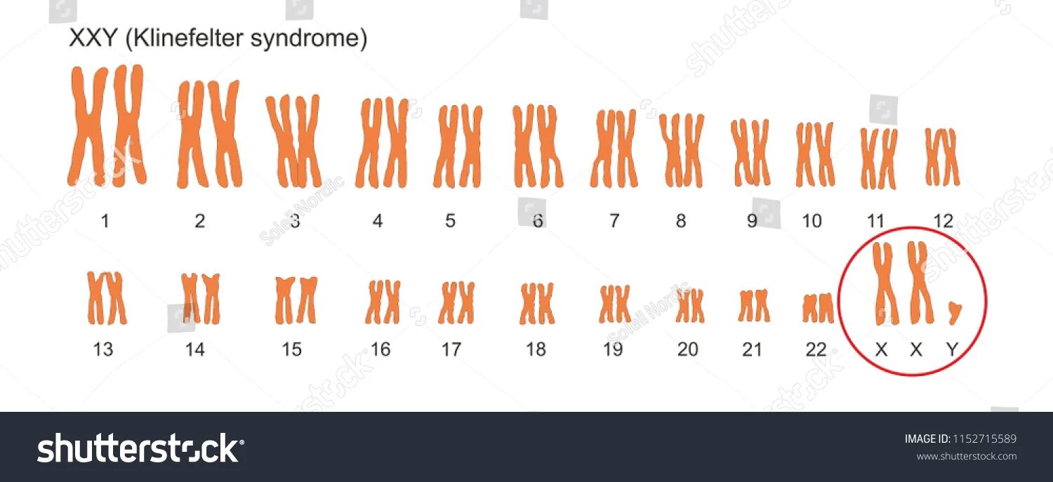 47 XYY кариотип. Синдром дополнительной y хромосомы. Дисомия y хромосомы. Дисомии по y-хромосоме. Поворот хромосом на 180 градусов