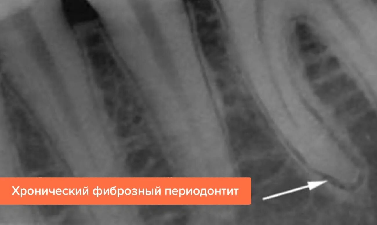 Фиброзный периодонтит. Периодонтит фиброзный гранулематозный гранулирующий. Острый апикальный периодонтит рентген. Хронический фиброзный периодонтит рентгенограмма. Фиброзный апикальный периодонтит.