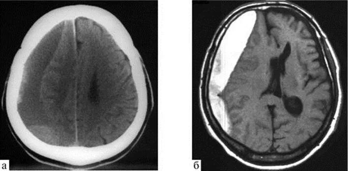 Черепно мозговые гематомы. Подострая субдуральная гематома на кт. Субдуральная гематома на кт. Хроническая субдуральная гематома мрт. Субдуральная гематома кт картина.