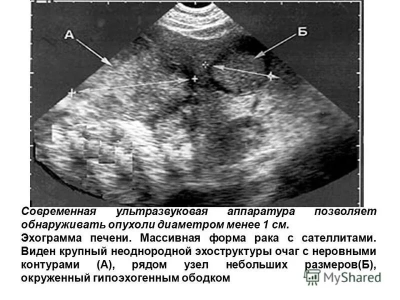 Изменение эхоструктуры печени