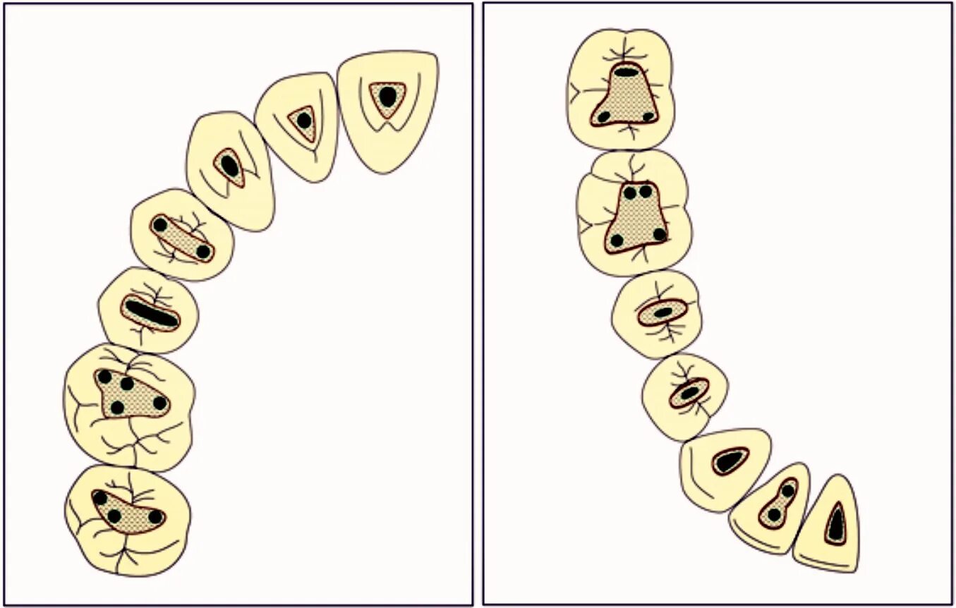 Топография устьев корневых каналов зубов верхней челюсти. Схема устьев корневых каналов. Схема расположения устьев корневых каналов. Топография устьев корневых каналов зубов нижней челюсти.