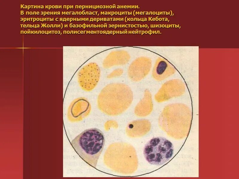 Пониженные макроциты. Гипопластическая анемия картина крови. Апластическая анемия мазок крови. Гипопластическая анемия мазок крови. Картина крови при апластическая анемия.