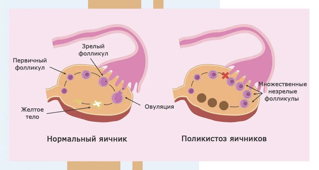 Функционирующий яичник