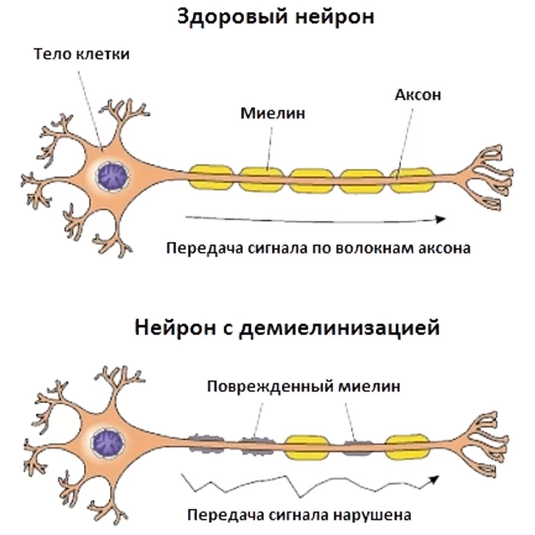 Включает несколько слоев нейронов. Нейрон Аксон миелиновая оболочка. Рассеянный склероз миелиновая оболочка. Миелиновая оболочка головного мозга. Повреждение миелиновой оболочки нейронов.