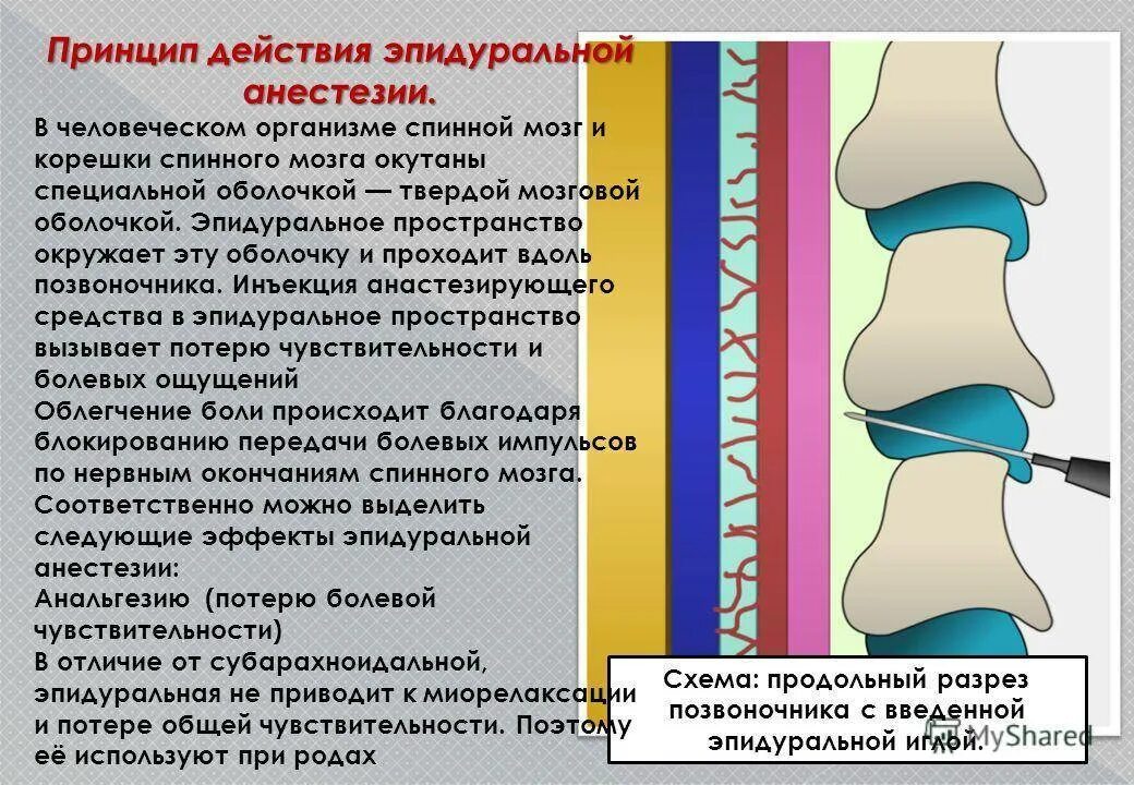 Боли в спине после эпидуральной