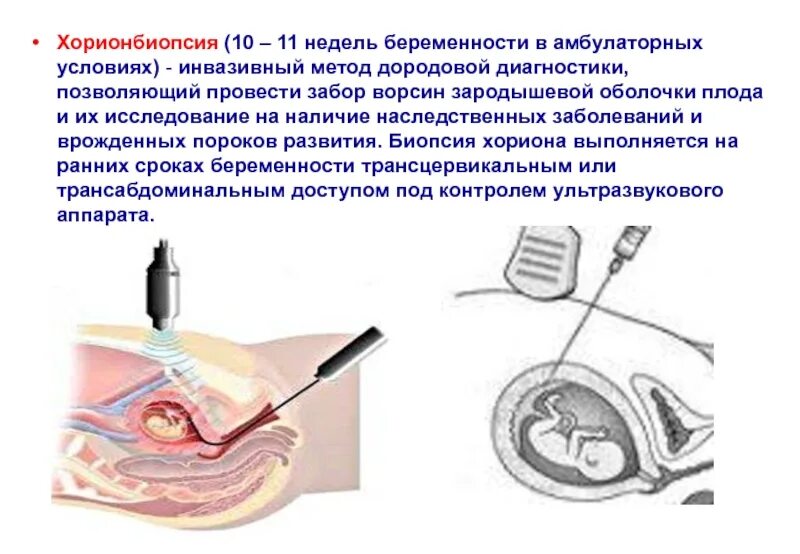 Инвазивный тест при беременности. Биопсия хориона амниоцентез кордоцентез. Трансабдоминальная биопсия хориона. Амниоскопия, хорионбиопсия, амниоцентез. Трансцервикальная биопсия ворсин хориона.