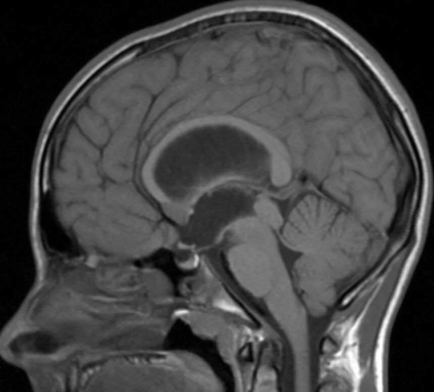 Операция гидроцефалия мозга. Гидроцефалия головного мозга мрт. Викарная гидроцефалия мрт. Наружная гидроцефалия головного мозга мрт. Тетравентрикулярная гидроцефалия.