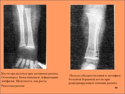 Деформация кости