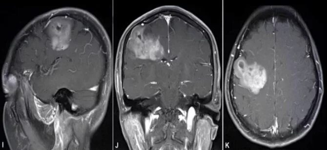 Анапластическая олигодендроглиома. Опухоль теменной доли мрт. Опухоль головного мозга глиобластома. Олигодендроглиома головного мозга мрт. Глиальная опухоль головного
