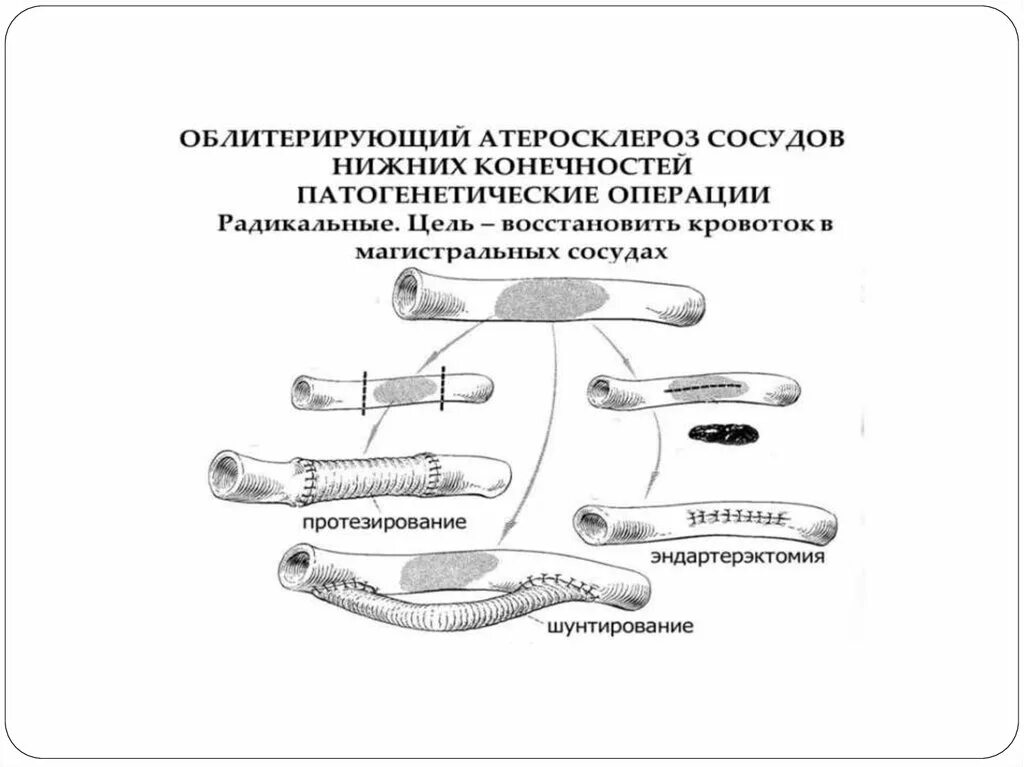 Шунтирование нижних конечностей. Протезирование сосудов. Протезирование артерий. Протезирование сосудов нижних конечностей.