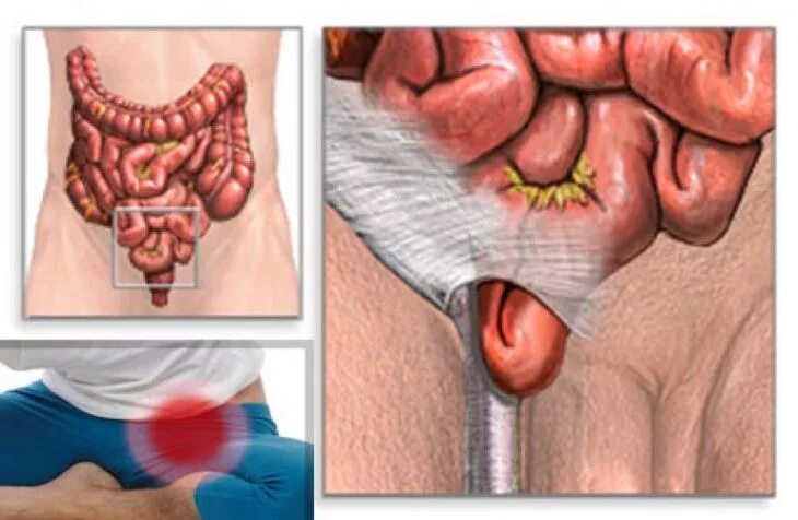 Паховая мошоночная грыжа. Рецидивная паховая грыжа. Операция паховая мошоночная грыжа. Боль в паху операции