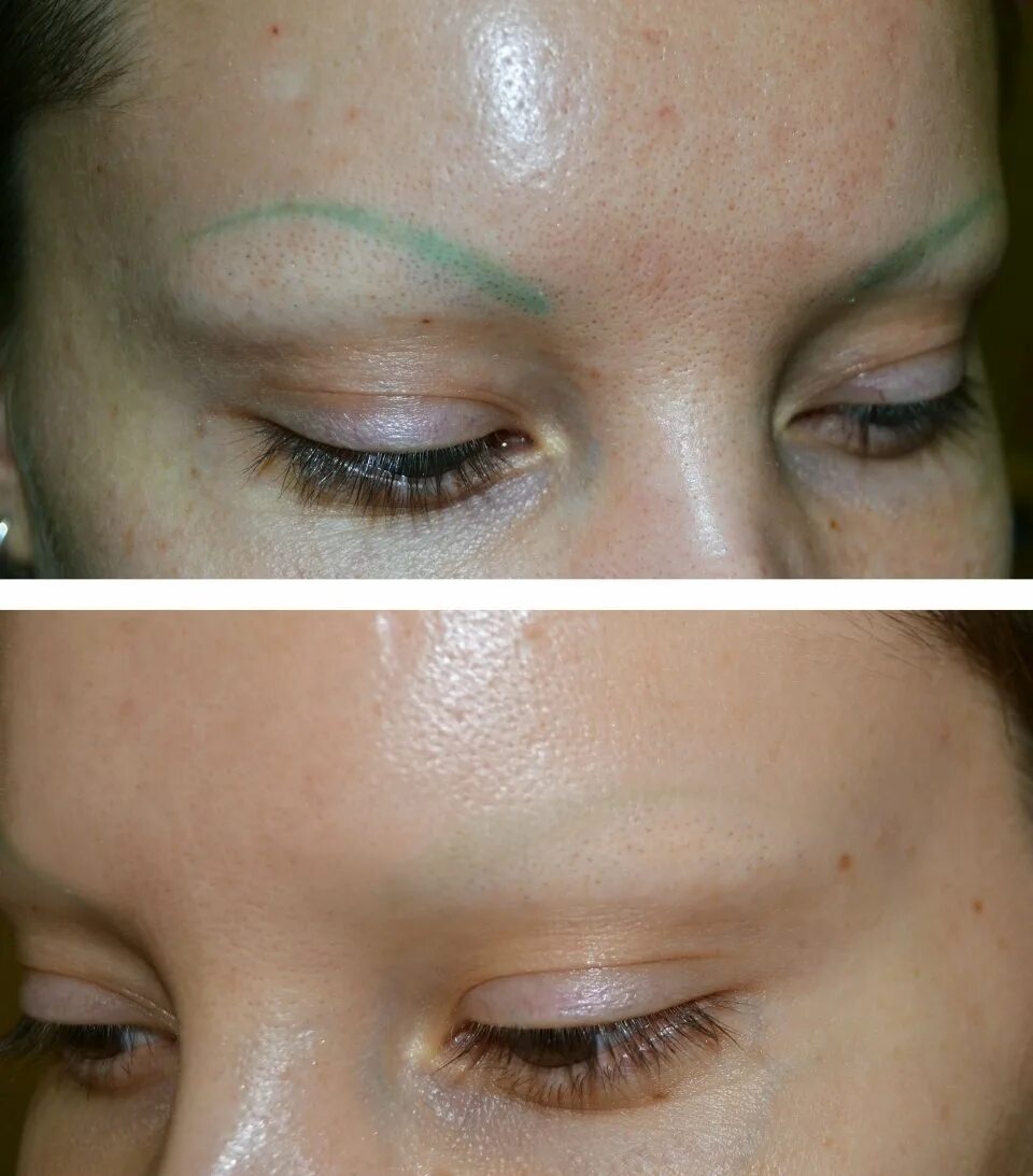 брови ремувером. удаление кислотным ремувером. брови ремувером. ремувер для снятия татуажа бровей. осветление перманентного макияжа бровей ремувером.