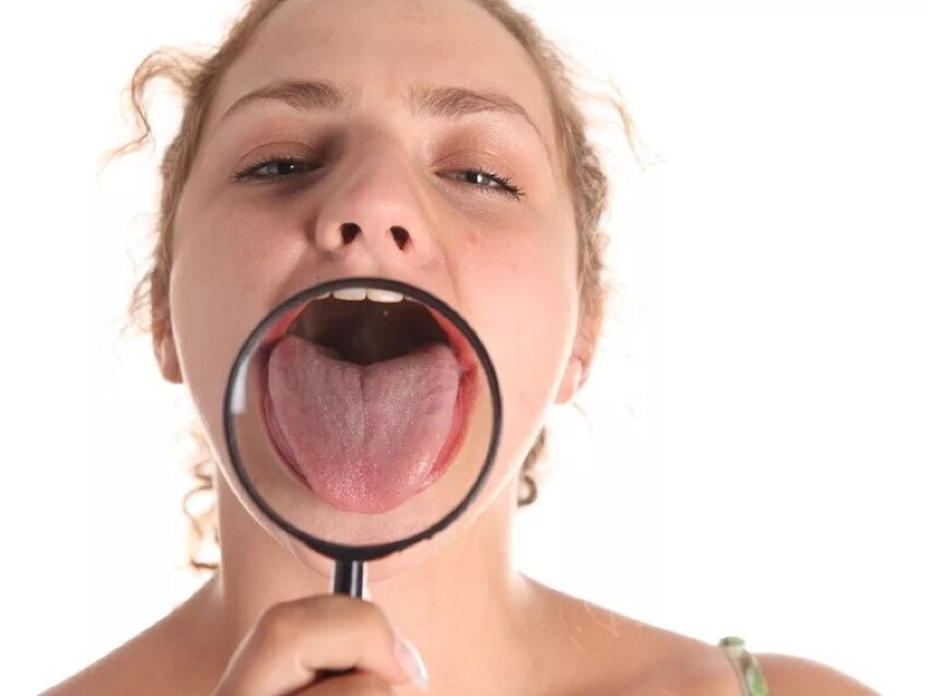 склерозирующий глоссит. мало слюны во рту. мало слюны во рту. желучный налет на языке. мало слюны во рту.