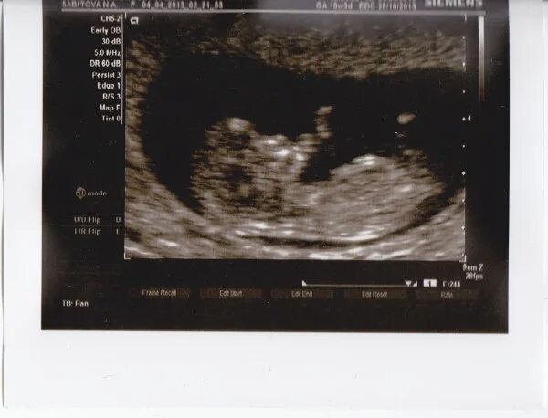 снимок узи 11 недель беременности. пол плода на узи в 12 недель беременности. узи ребенка 11 недель. 11 недель беременности фото плода на узи пол ребенка. узи плода на 11 акушерской неделе.