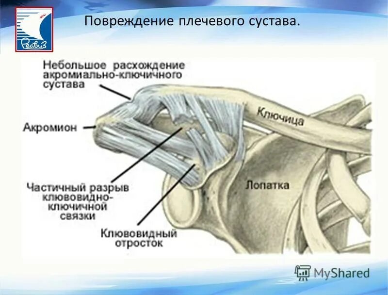 Повреждение акромиально ключичного