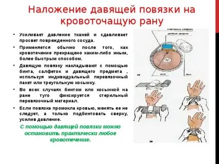 Давящая повязка при кровотечении