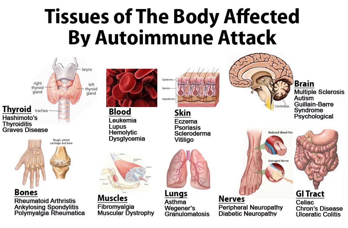 Classification of autoimmune diseases. Reduce disease