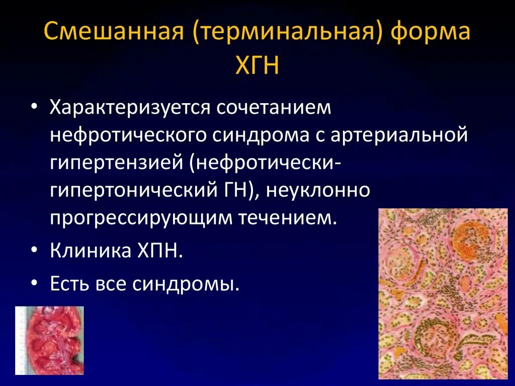 Триада симптомов при остром гломерулонефрите
